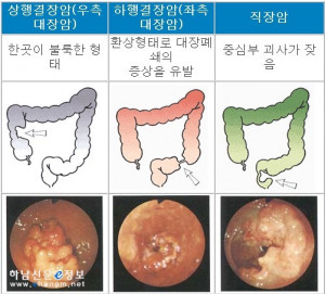 대장암 ｢결장암과 직장암｣